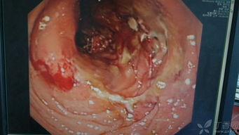 电子肠镜视频,肠道健康全景展现