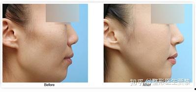 颧骨手术3d视频,术前术后全流程揭秘