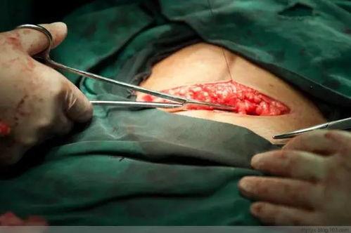 剖宫产视频全部过程,从麻醉到缝合，带你了解分娩的另一面