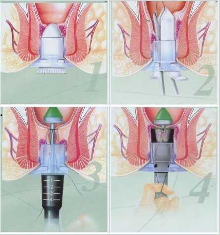 pph痔疮手术视频过程,微创治疗痔疮的全新体验